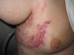 Hidradenitis Suppurativa - treatment