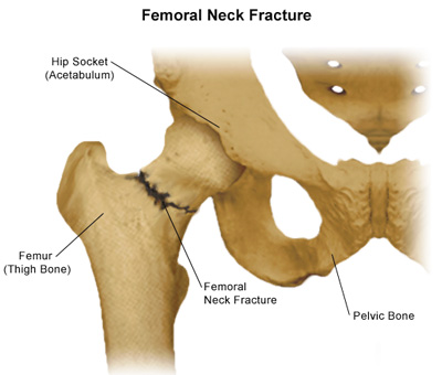 Hip Fracture in Older Adults