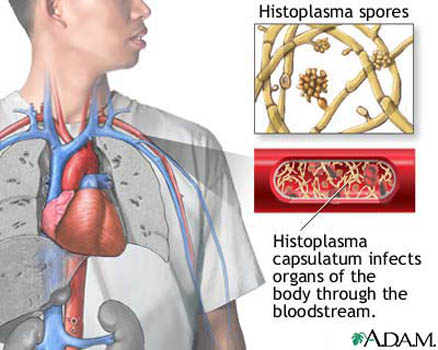 Histoplasmosis - diagnosis, symptoms and treatment