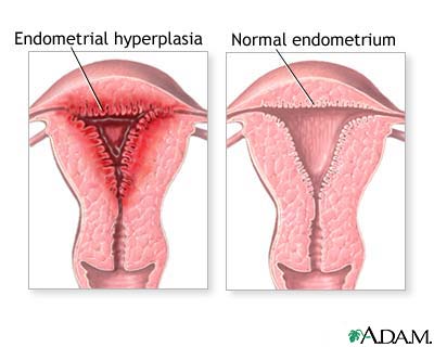 Hyperplasia, Endometrial hyperplasia, cells and cancer