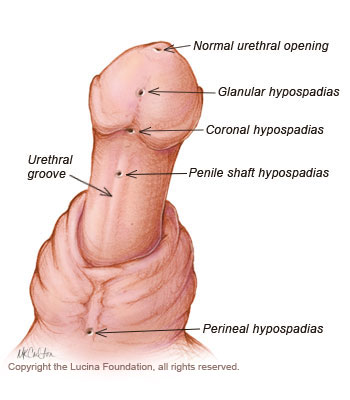 Hypospadias - definition, treatment, repair and surgery