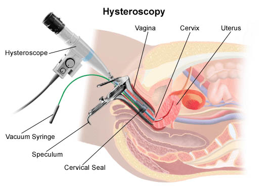 Hysteroscopy procedure - risks and side effects