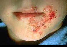 Impetigo - treatment, causes and symptoms