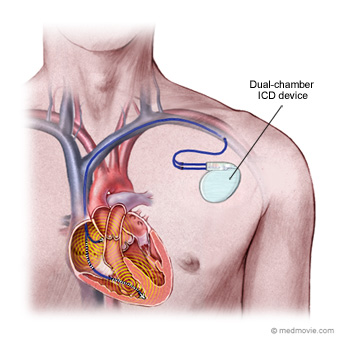 Implantable cardioverter defibrillator (ICD)