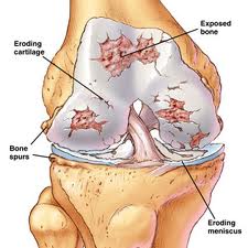 Infectious Arthritis - treatment