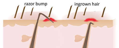 Ingrown Hair - infection and treatment
