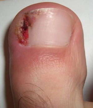 Ingrown Nail - treatment