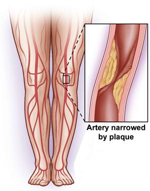 Intermittent Claudication - symptoms and treatment