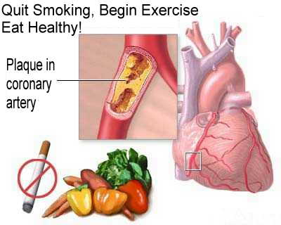 Ischemic Heart Disease (IHD) - symptoms and treatment