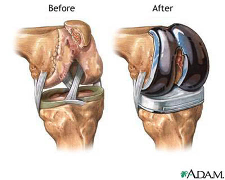 Joint Replacement surgery / surgical operation, risks