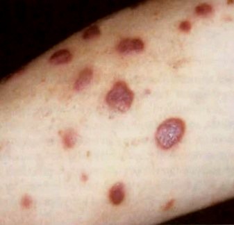 Kaposi’s sarcoma - cancer skin - treatment and symptoms