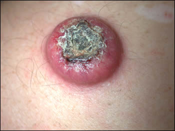 Keratoacanthoma - skin cancer - treatment