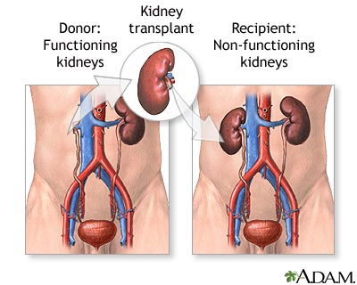 Kidney Donor - Transplant and Living Kidney Donor