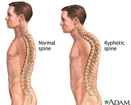 Kyphosis of spine - definition and treatement