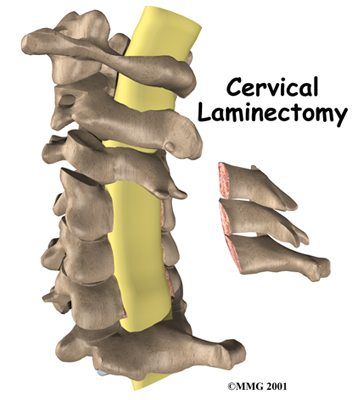 Laminectomy surgery and recovery