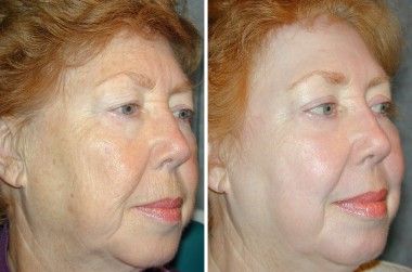 What is Laser Skin Resurfacing