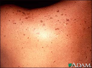 Lentigines - dark spots - treatment