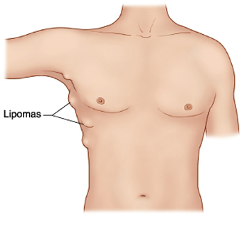 Lipoma - treatment, removal and surgery