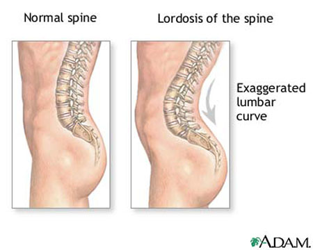 Lordosis of the spine - causes and treatment