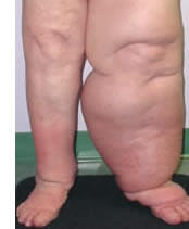 Lymphedema - treatment and therapy