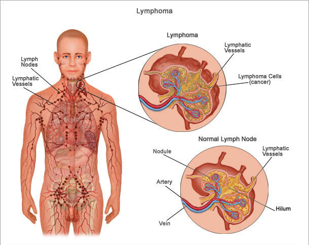 Lymphoma - symptoms and treatment