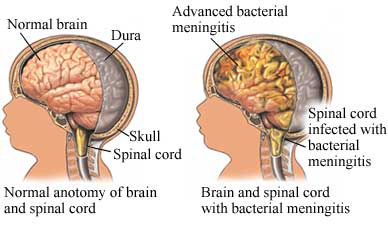 Meningitis (viral infection) - symptoms and treatment