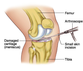 Meniscectomy and operation knee