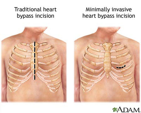 Minimally Invasive Cardiac Surgery