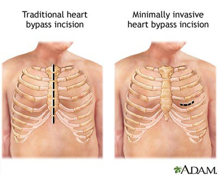 Minimally Invasive Cardiac Surgery