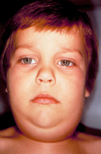 Mumps virus - symptoms and treatment