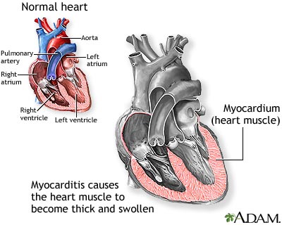 Myocarditis - symptoms, treatment and causes