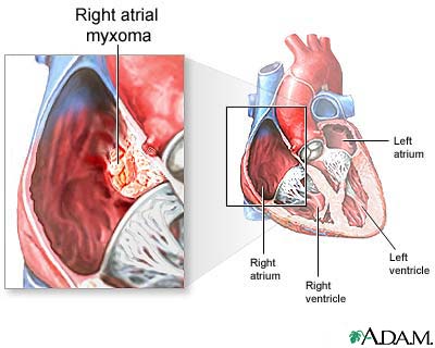 Myxoma (heart tumor), treatment and surgery