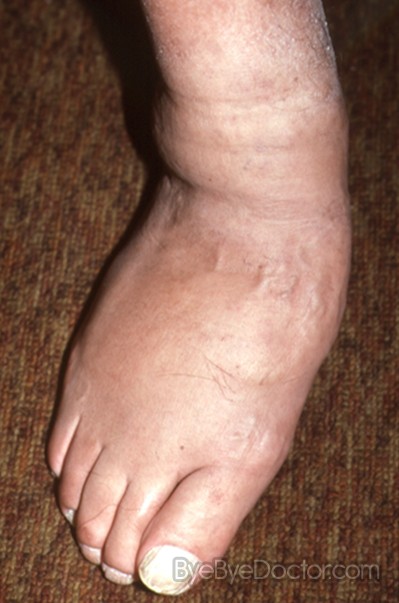 Arthropathy, Neurogenic; Charcot's Joint