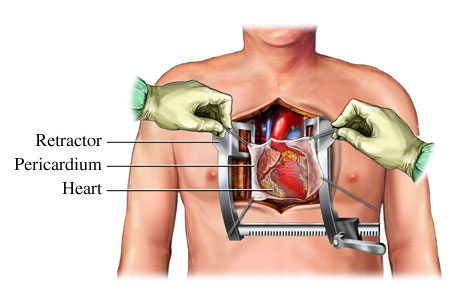 Open Heart Surgery - procedure and recovery