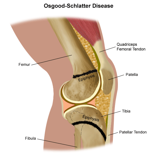 Osgood-Schlatter disease/syndrome - symptoms and treatment