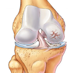 Osteoarthritis - symptoms and treatment