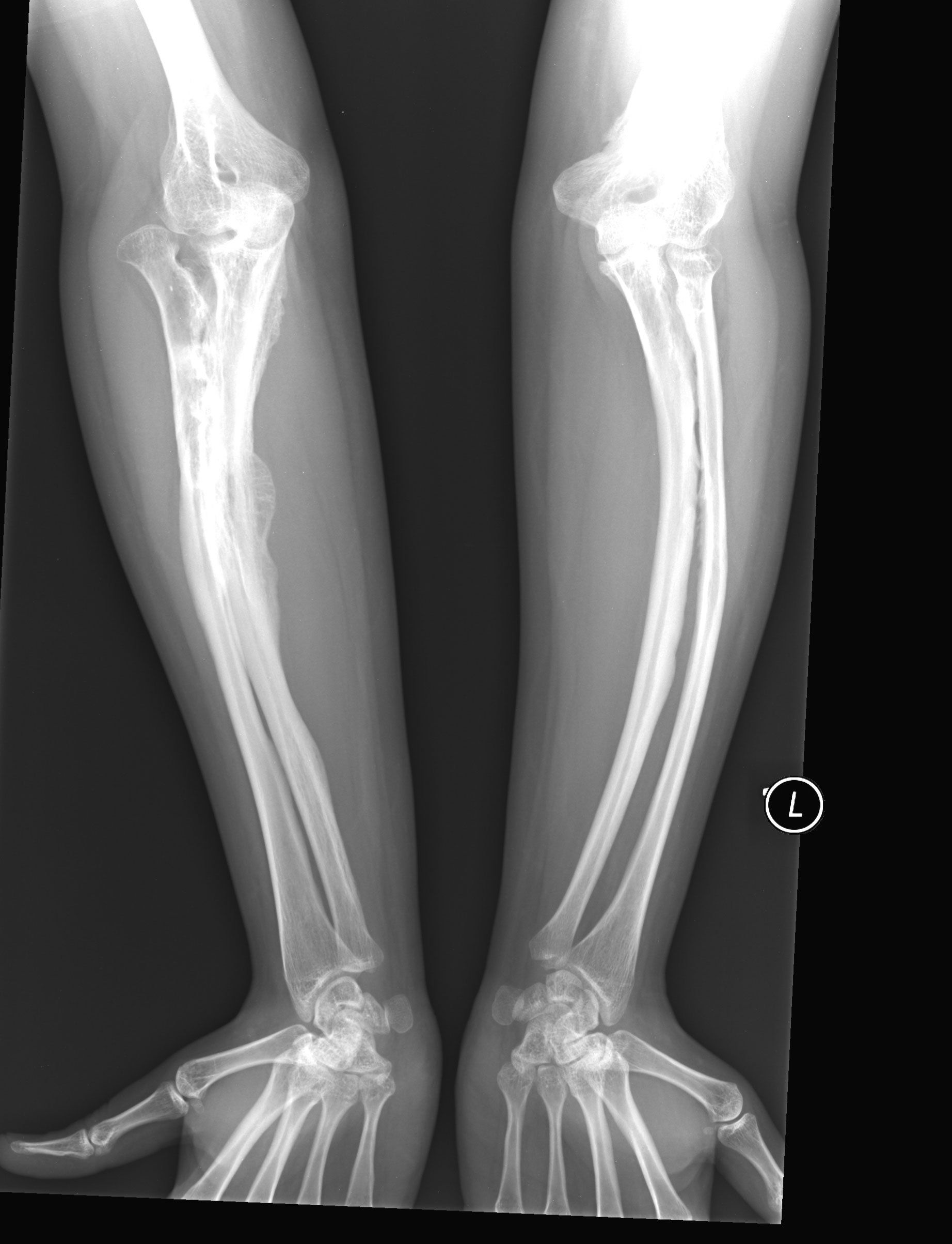 Osteogenesis imperfecta - types and treatment