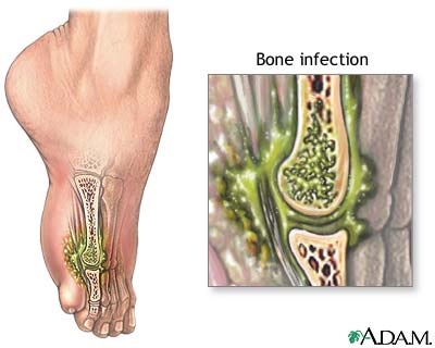 Osteomyelitis - definition, symptoms and treatment