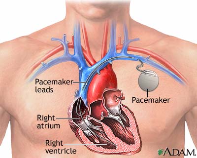 Pacemaker definition, surgery and implanting