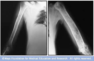 Paget’s disease of the bone - symptoms and treatment