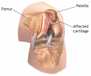 Patellofemoral syndrome - pain, symptoms and treatment