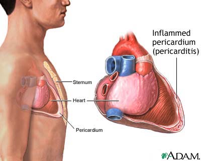 Pericarditis - symptoms and treatment