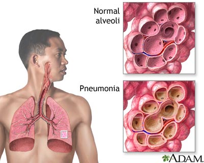 Pneumococcal pneumonia - symptoms and treatment