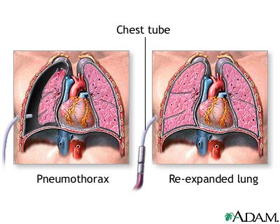 Pneumothorax - definition, symptoms and treatment