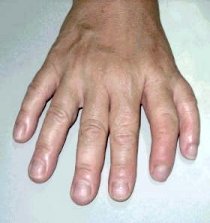 Polydactyly - extra fingers or toes