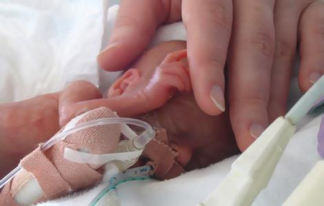 Premature Birth - what is and causes