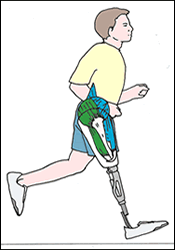 Prosthetic Limb - amr, leg, hand, foot