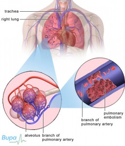 Pulmonary embolism - diagnosis, symptoms and treatment