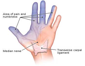 Repetitive Motion Injuries