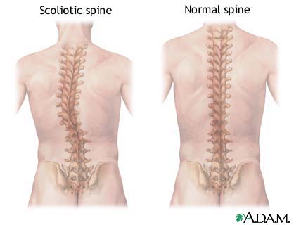 Scoliosis of the spine - symptoms and treatment